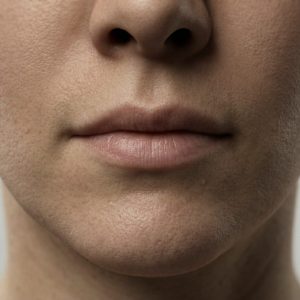 Chin Augmentation
