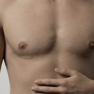 Gynecomastia