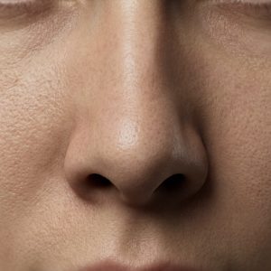 Rhinoplasty (Nose Surgery