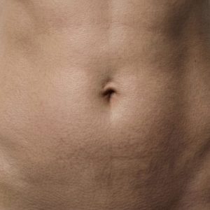 Tummy Tuck